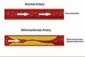 Atherosclerosis of the heart